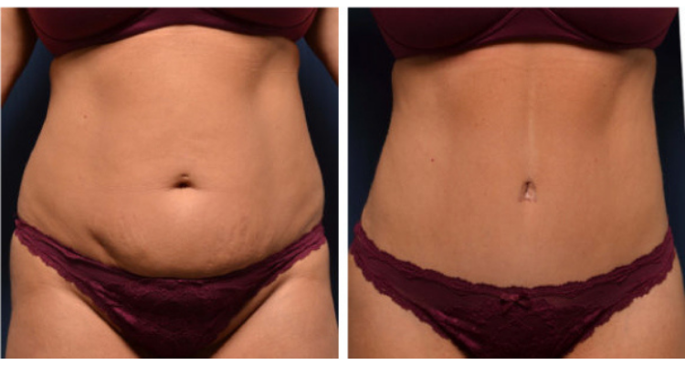 Amaira Med Spa & Surgical tummy tuck result — Fort Lauderdale, FL