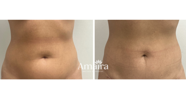 Liposuction result at Amaira Med Spa & Surgical in Fort Lauderdale, FL