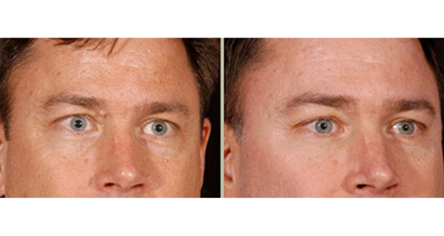 Fat Transfer result at Amaira Med Spa & Surgical in Fort Lauderdale, FL
