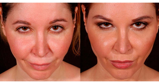 Blepharoplasty result at Amaira Med Spa & Surgical in Fort Lauderdale, FL