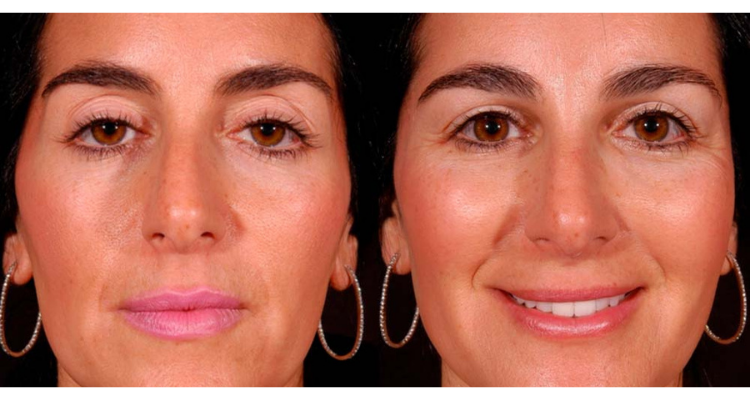 Amaira Med Spa & Surgical blepharoplasty result — Fort Lauderdale, FL