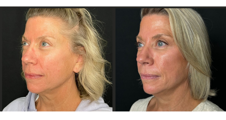 Amaira Med Spa & Surgical bbl result — Fort Lauderdale, FL