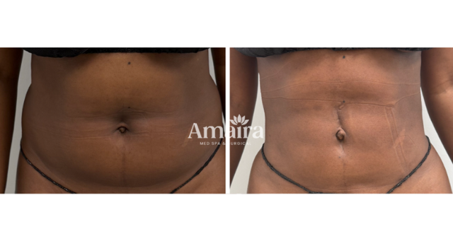 Liposuction result at Amaira Med Spa & Surgical in Fort Lauderdale, FL