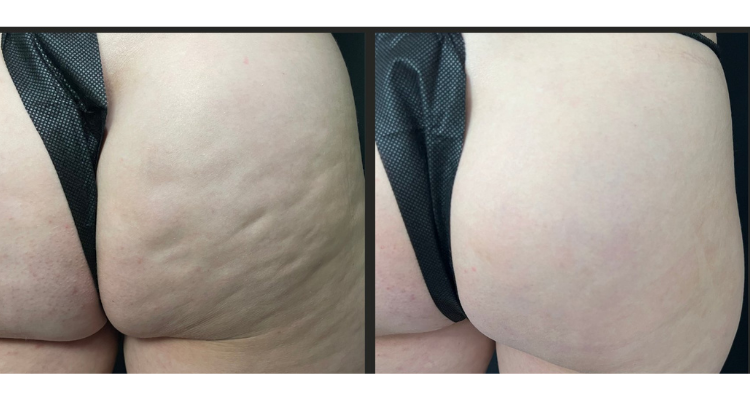 Amaira Med Spa & Surgical bbl result — Fort Lauderdale, FL