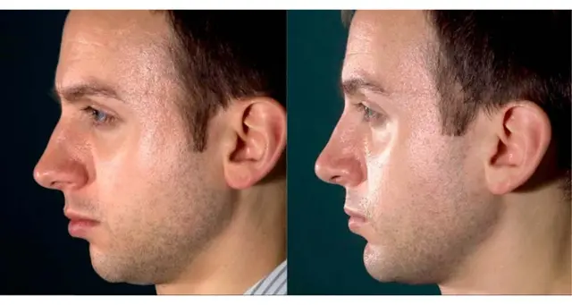 Rhinoplasty result at Amaira Med Spa & Surgical in Fort Lauderdale, FL