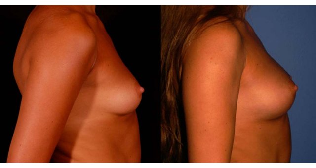 Breast Augmentation result at Amaira Med Spa & Surgical in Fort Lauderdale, FL