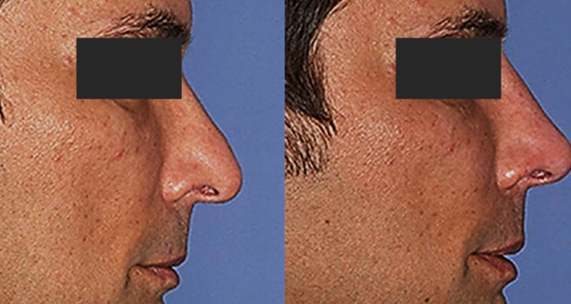 Rhinoplasty result at Amaira Med Spa & Surgical in Fort Lauderdale, FL