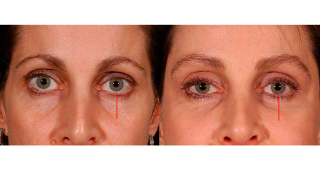 Blepharoplasty result at Amaira Med Spa & Surgical in Fort Lauderdale, FL