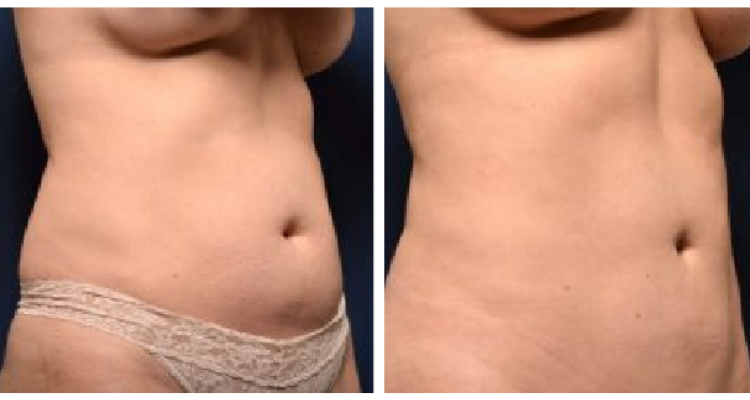 Amaira Med Spa & Surgical tummy tuck result — Fort Lauderdale, FL