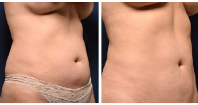 Tummy Tuck result at Amaira Med Spa & Surgical in Fort Lauderdale, FL