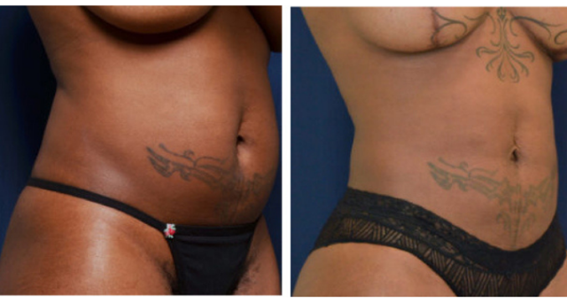 Tummy Tuck result at Amaira Med Spa & Surgical in Fort Lauderdale, FL