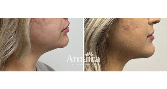 Liposuction result at Amaira Med Spa & Surgical in Fort Lauderdale, FL