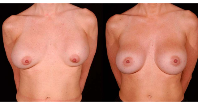 Breast Augmentation result at Amaira Med Spa & Surgical in Fort Lauderdale, FL