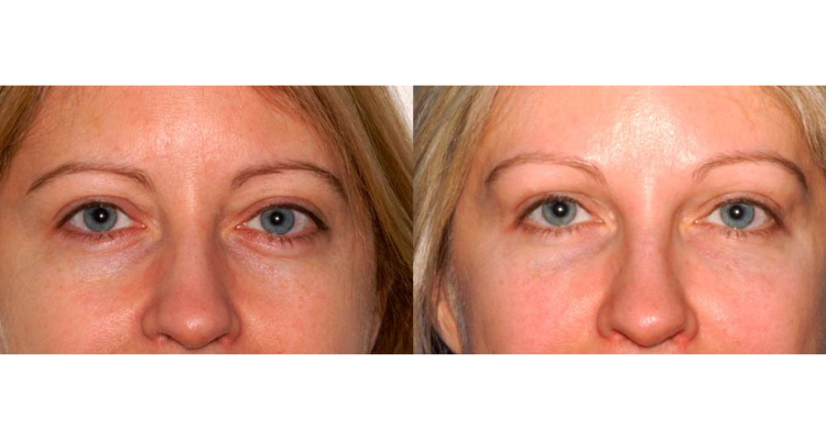 Amaira Med Spa & Surgical blepharoplasty result — Fort Lauderdale, FL