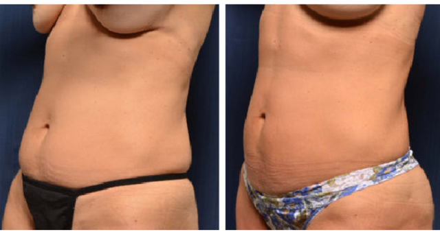 Tummy Tuck result at Amaira Med Spa & Surgical in Fort Lauderdale, FL