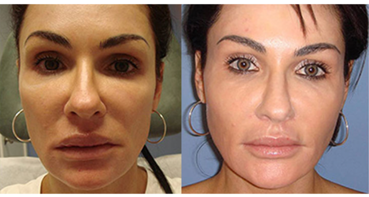 Amaira Med Spa & Surgical fat transfer result — Fort Lauderdale, FL