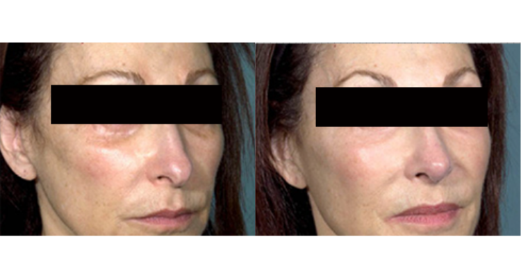Amaira Med Spa & Surgical rhinoplasty result — Fort Lauderdale, FL