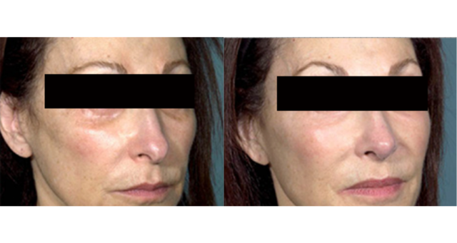 Rhinoplasty result at Amaira Med Spa & Surgical in Fort Lauderdale, FL