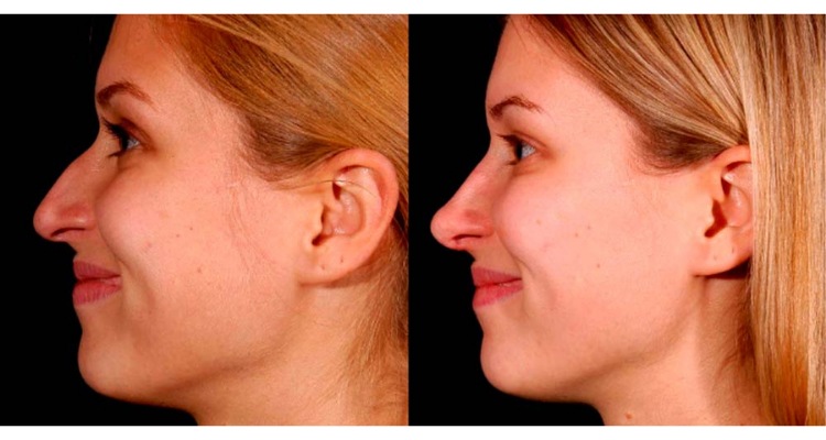 Amaira Med Spa & Surgical rhinoplasty result — Fort Lauderdale, FL
