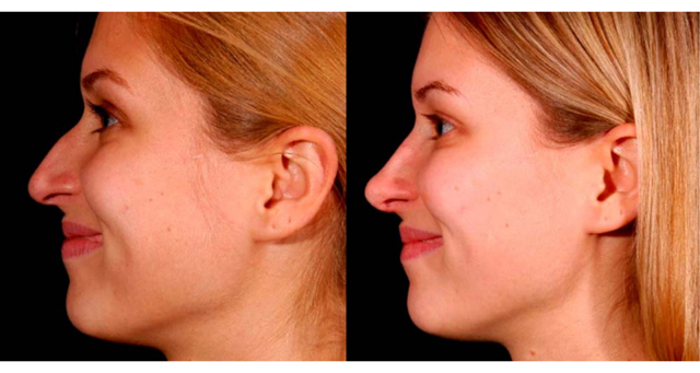 Rhinoplasty result at Amaira Med Spa & Surgical in Fort Lauderdale, FL