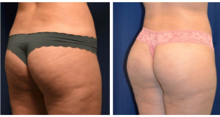 Amaira Med Spa & Surgical bbl result — Fort Lauderdale, FL