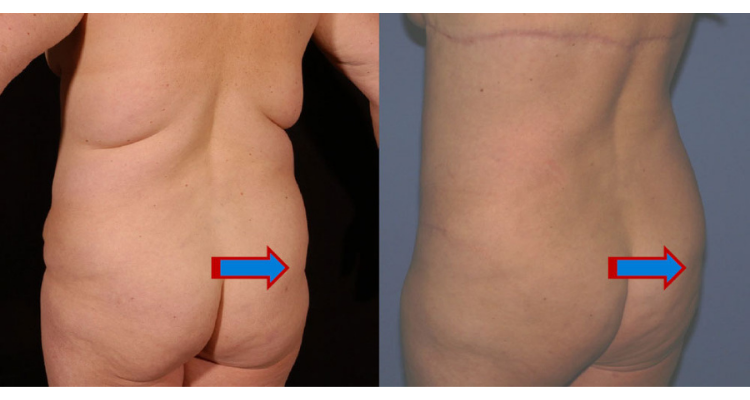 Amaira Med Spa & Surgical bbl result — Fort Lauderdale, FL