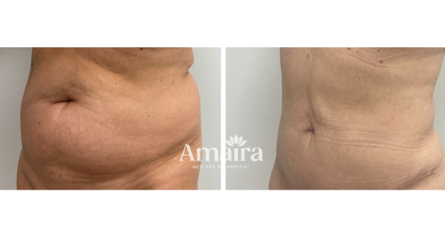 Liposuction result at Amaira Med Spa & Surgical in Fort Lauderdale, FL