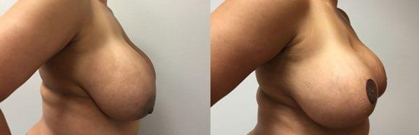 Kronowitz Plastic Surgery breast reduction result — Bellaire, TX