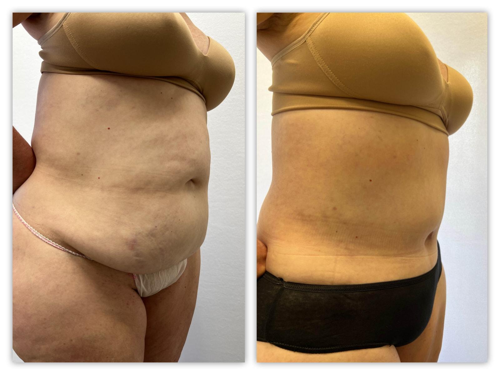 Kronowitz Plastic Surgery tummy tuck result — Bellaire, TX