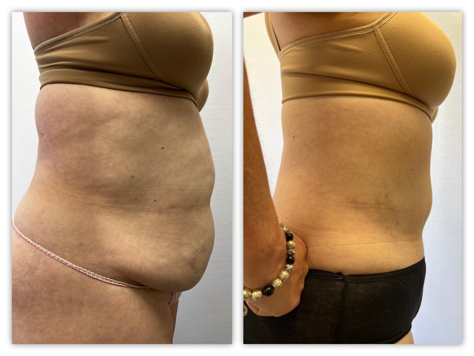 Kronowitz Plastic Surgery tummy tuck result — Bellaire, TX