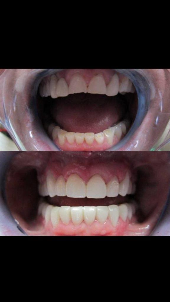 Dental Crowns result at Torghele Dentistry in Ogden, UT