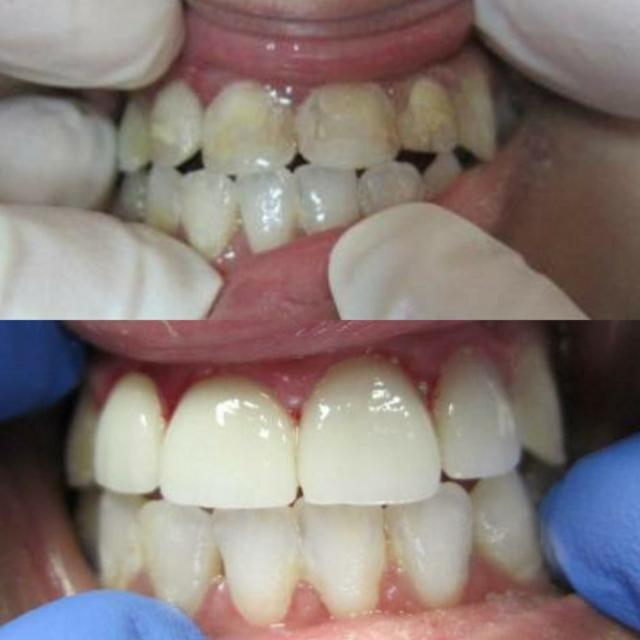 Dental Crowns result at Torghele Dentistry in Ogden, UT