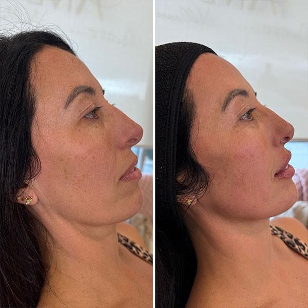 Jawline Filler result at Aive Aesthetics in Draper, UT