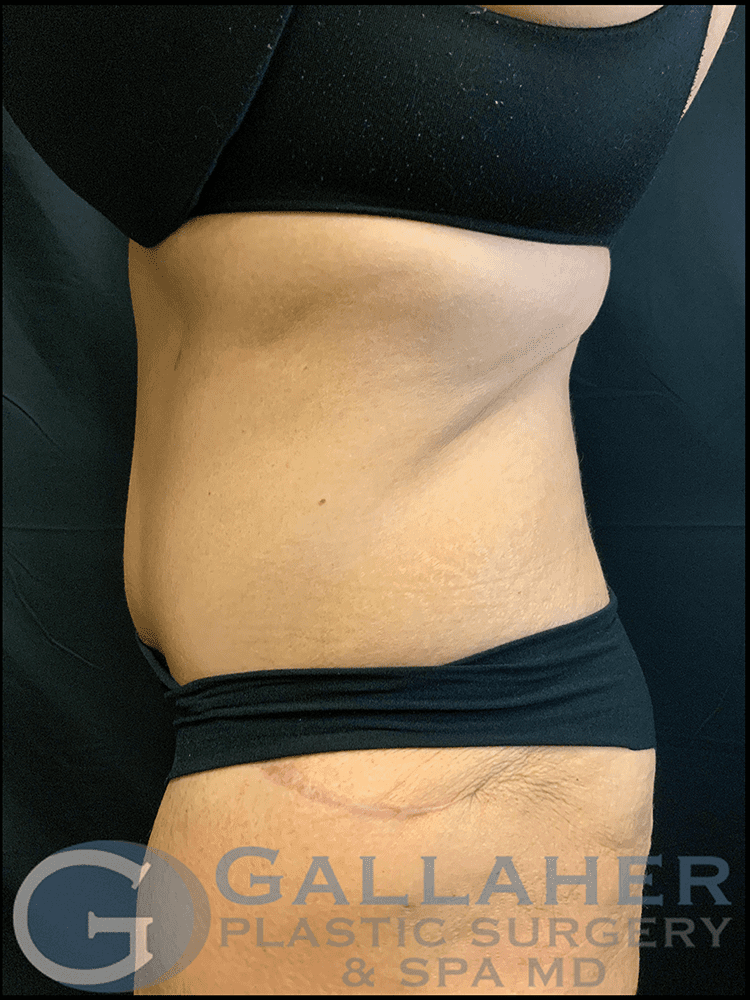 Gallaher Plastic Surgery & Spa MD tummy tuck after — Knoxville, TN