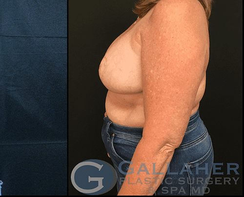 Breast Reduction after at Gallaher Plastic Surgery & Spa MD in Knoxville, TN