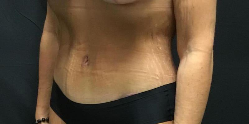 Gallaher Plastic Surgery & Spa MD tummy tuck after — Knoxville, TN