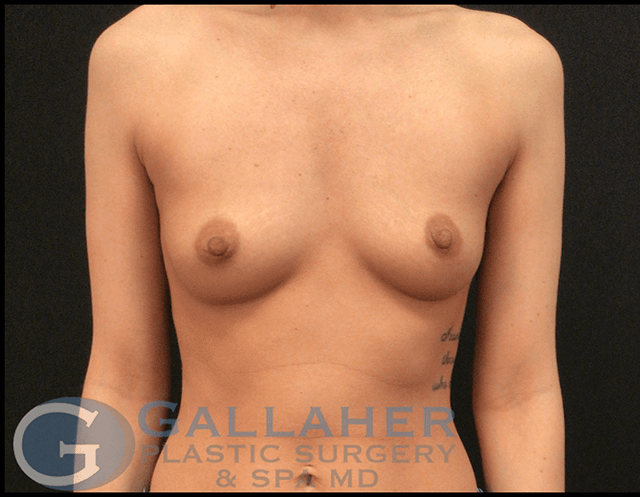 Breast Augmentation before at Gallaher Plastic Surgery & Spa MD in Knoxville, TN