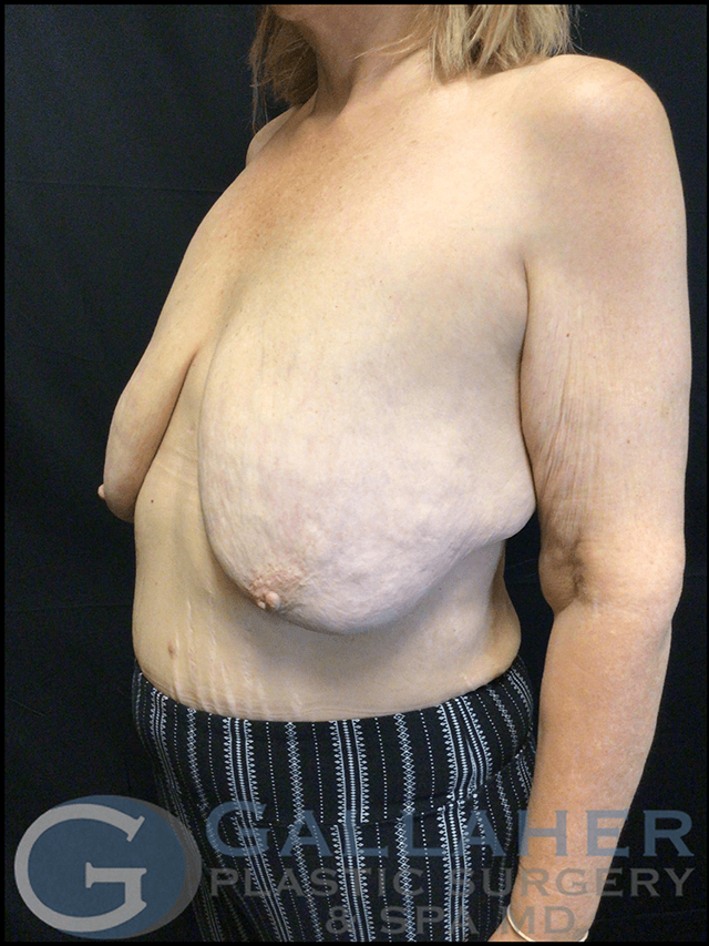 Breast Lift before at Gallaher Plastic Surgery & Spa MD in Knoxville, TN