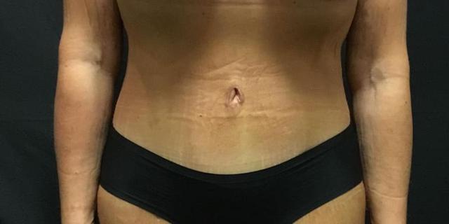 Tummy Tuck after at Gallaher Plastic Surgery & Spa MD in Knoxville, TN