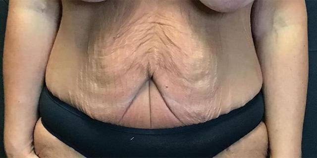 Tummy Tuck before at Gallaher Plastic Surgery & Spa MD in Knoxville, TN