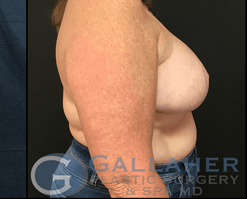 Gallaher Plastic Surgery & Spa MD breast reduction after — Knoxville, TN
