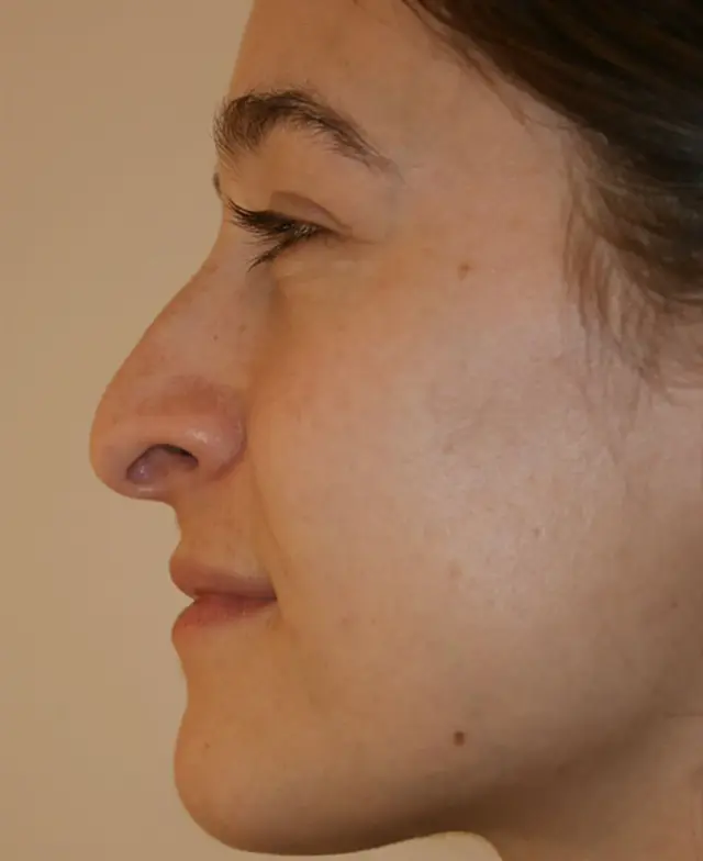 Rhinoplasty before at Aesthetx in Campbell, CA