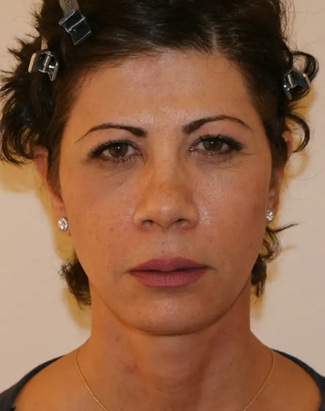 Facelift after at Aesthetx in Campbell, CA