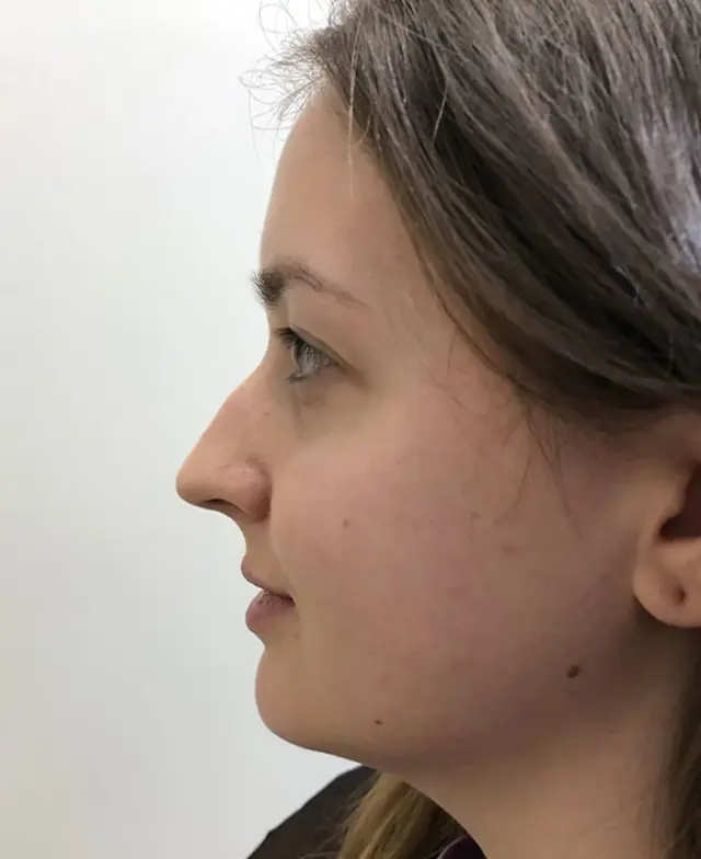 Rhinoplasty before at Aesthetx in Campbell, CA