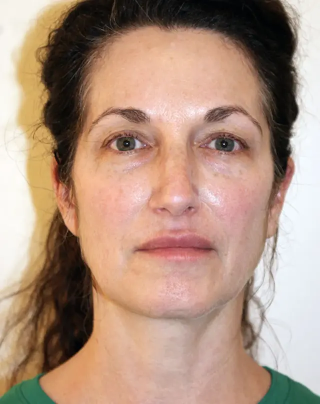 Facelift before at Aesthetx in Campbell, CA