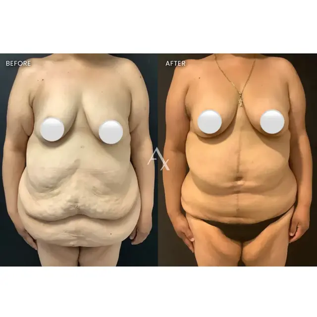 Tummy Tuck result at Aesthetx in Campbell, CA