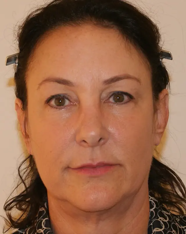 Facelift before at Aesthetx in Campbell, CA