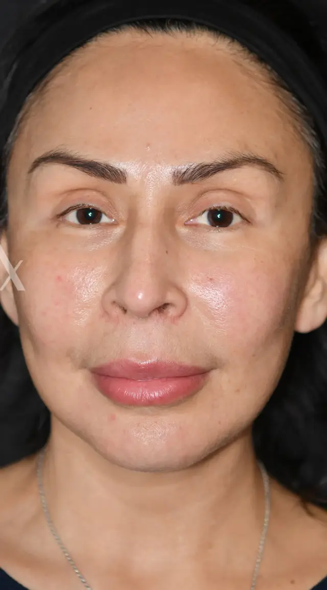 Facelift after at Aesthetx in Campbell, CA