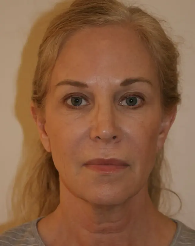 Facelift before at Aesthetx in Campbell, CA