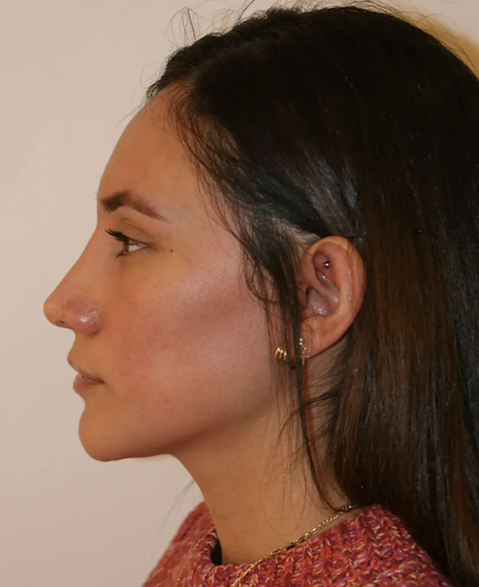 Aesthetx rhinoplasty after — Campbell, CA